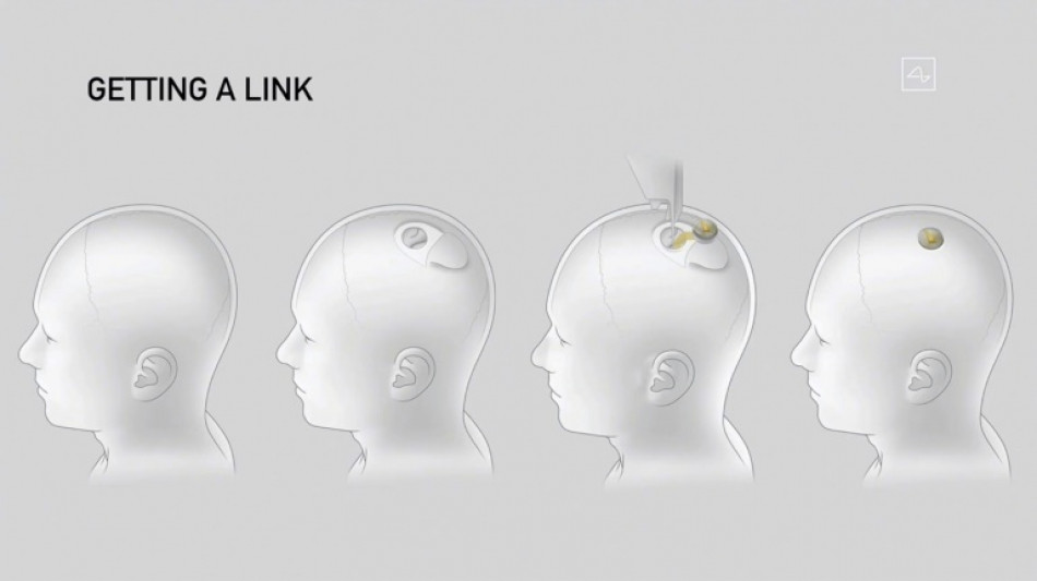 Musk dice que su empresa Neuralink instal&oacute; un implante cerebral en su primer paciente