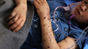 'I want my legs back': the child amputees of Gaza's war
